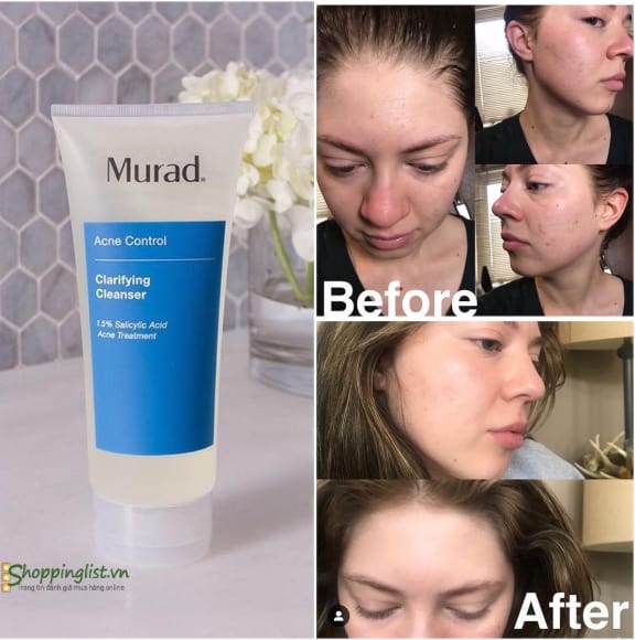 Kem trị mụn Murad Outsmart Acne Clarifying Treatment 